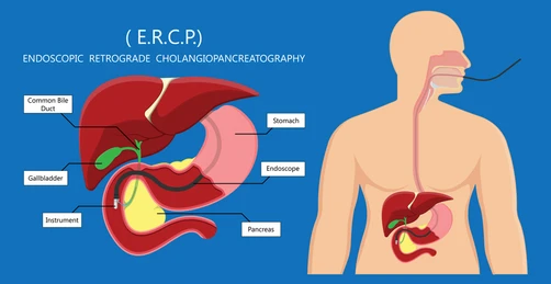 ercp treatment best ercp treatment in kalyan